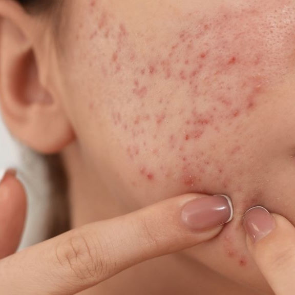 Microneedling treatment to reduce acne scars and improve skin texture