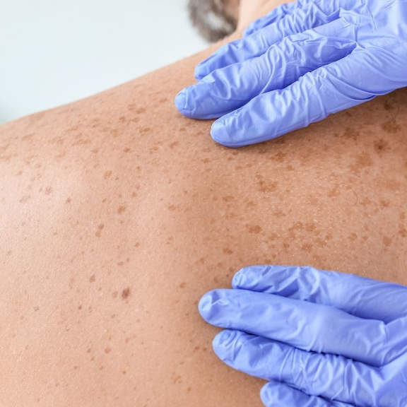 Laser pigmentation and sunspot removal at Fakour Clinic Richmond Hill