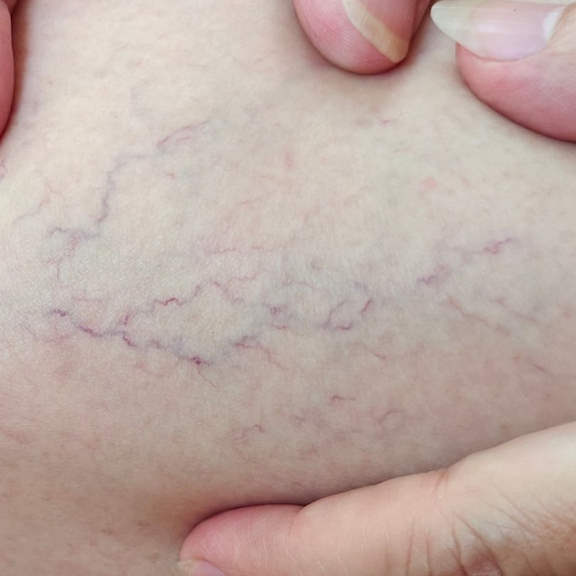 Laser spider vein removal in Richmond Hill Fakour Clinic