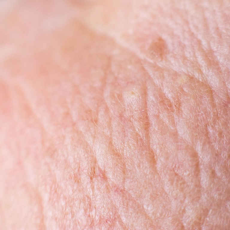 Laser wrinkle treatment at Fakour Clinic Richmond Hill